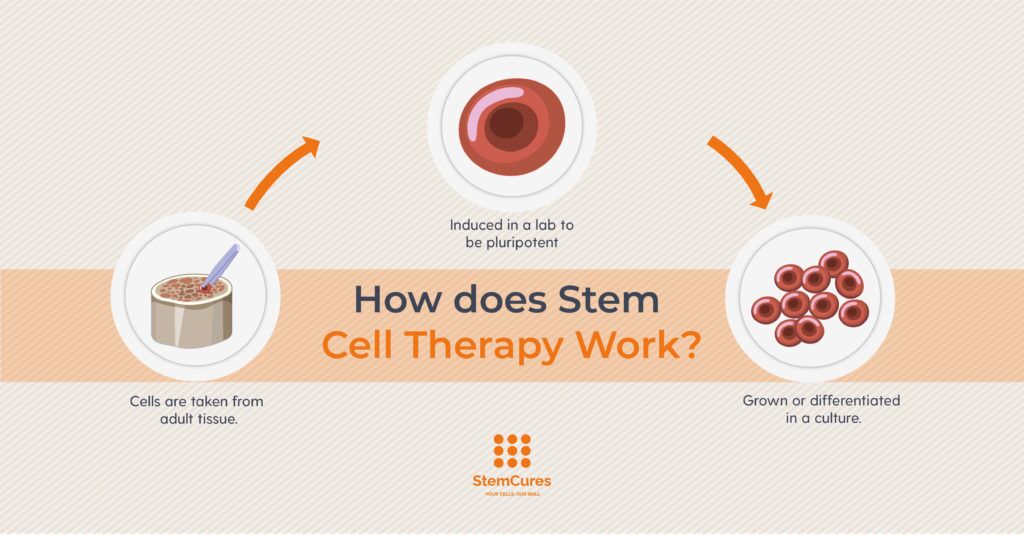 Stem Cell Therapy for Meniscus Tears - Innovations Medical